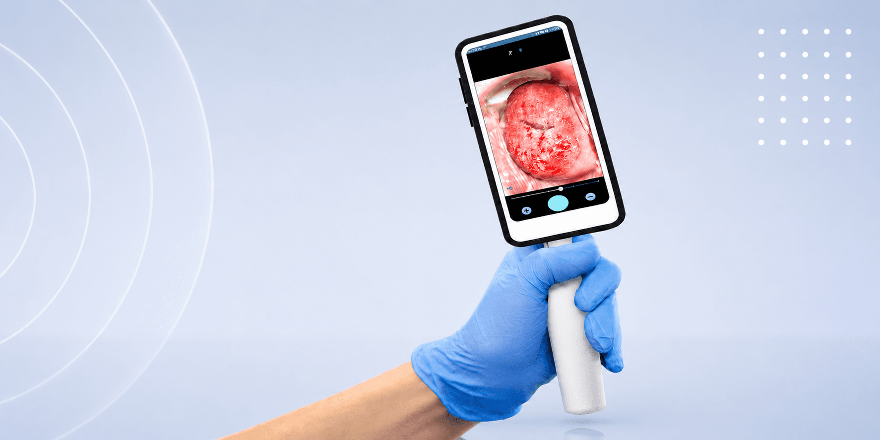 Smart Handheld Colposcope